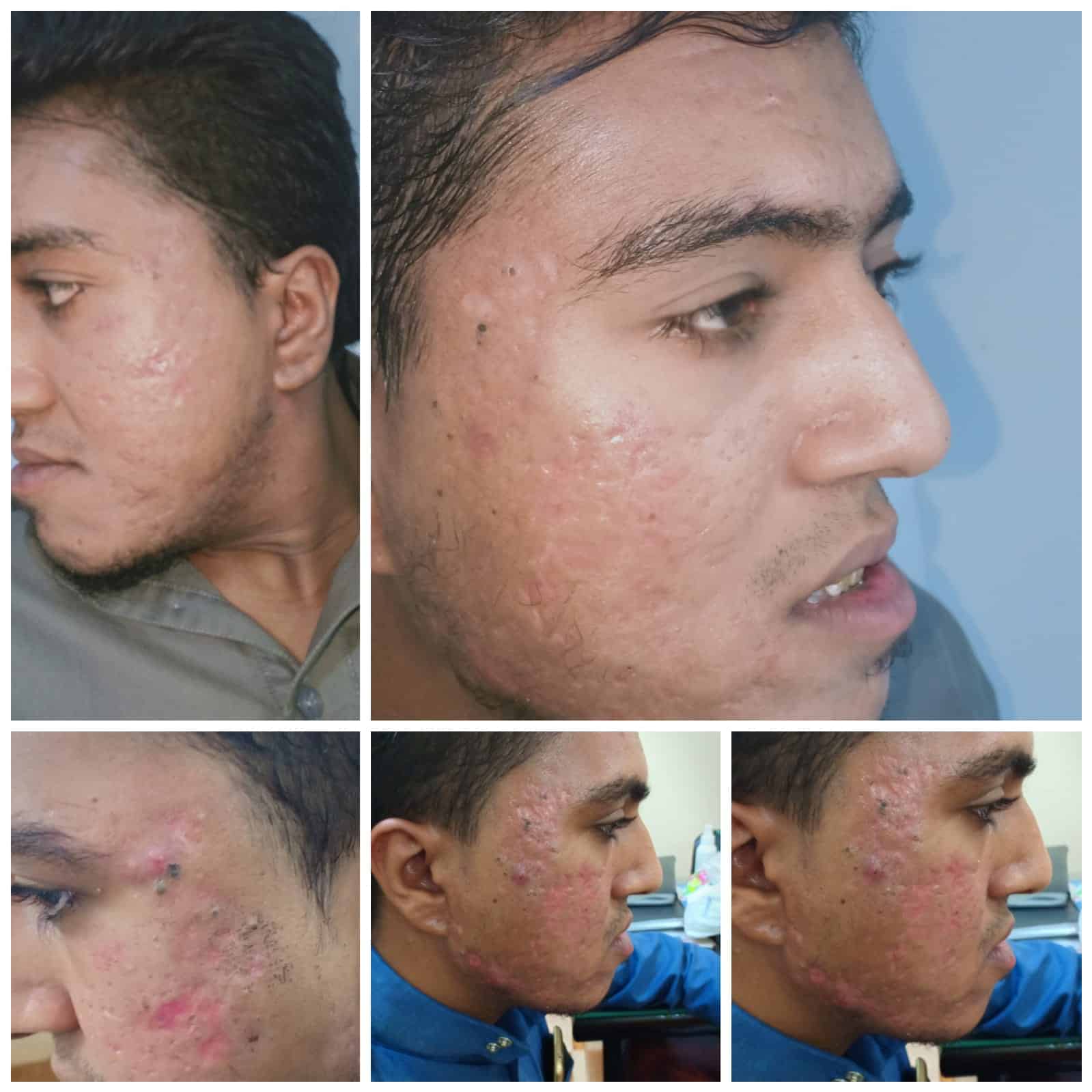 علاج حب الشباب في الغردقة